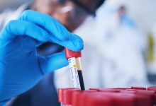 محققان: با هوش مصنوعی و یک آزمایش خون جدید می‌توان آرتروز را 8 سال زودتر پیش‌بینی کرد