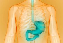 روش زاپینگ معده از طریق کاهش اشتها منجر به کاهش وزن میشود