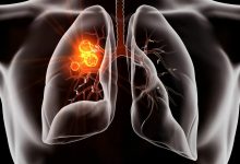 قرص جدید سرطان ریه در آزمایشهای بالینی عملکرد قابلتوجهی از خود نشان داد