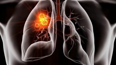 قرص جدید سرطان ریه در آزمایش‌های بالینی عملکرد قابل‌توجهی از خود نشان داد