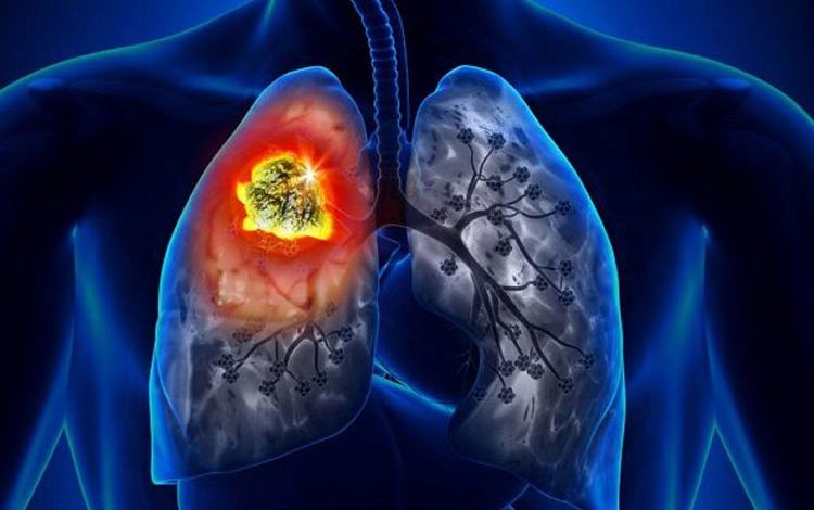 نتایج امیدوارکننده قرص سرطان ریه در آزمایش‌های انسانی
