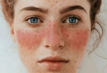 دانشمندان به ریشه بیماری خودایمنی «لوپوس» پی بردند