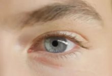 برآمدگیهای زردرنگ اطراف چشم میتواند با مشکل قلبی مرتبط باشد