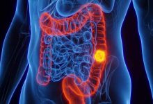 کمبود آهن می‌تواند نشانه‌ای از ابتلا به سرطان روده بزرگ در جوانان باشد