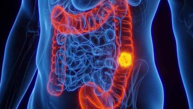 کمبود آهن میتواند نشانهای از ابتلا به سرطان روده بزرگ در جوانان باشد