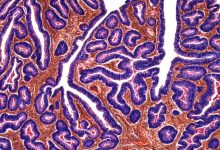 روند ابتلای جوانان به سرطان روده بزرگ در کشورهای توسعهیافته صعودی است