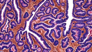 روند ابتلای جوانان به سرطان روده بزرگ در کشورهای توسعهیافته صعودی است