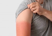 دانشمندان میگویند درباره علت آفتابسوختگی اشتباه میکردند