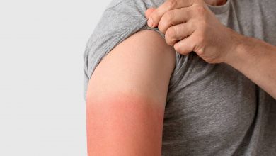 دانشمندان میگویند درباره علت آفتابسوختگی اشتباه میکردند