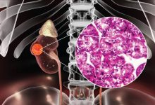 سرطان کلیه چیست و چه علائمی دارد؟